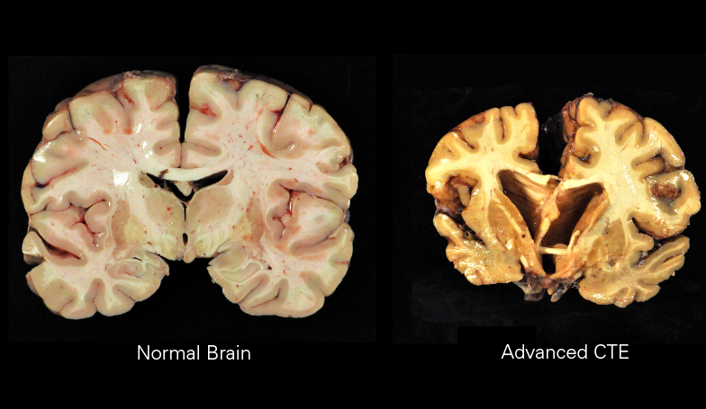 El CTE es un padecimiento que ha afectado gravemente a decenas de jugadores en la NFL llevándolos incluso a la muerte