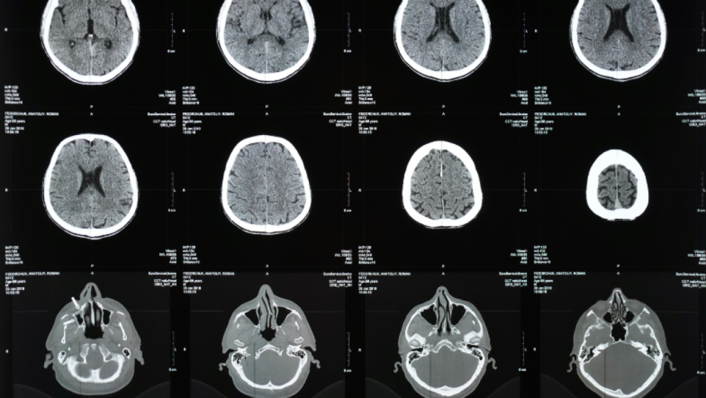 El CTE se desarrolla como consecuencia de repetidos golpes contra la cabeza que provocan traumatismos e inflamación del cerebro